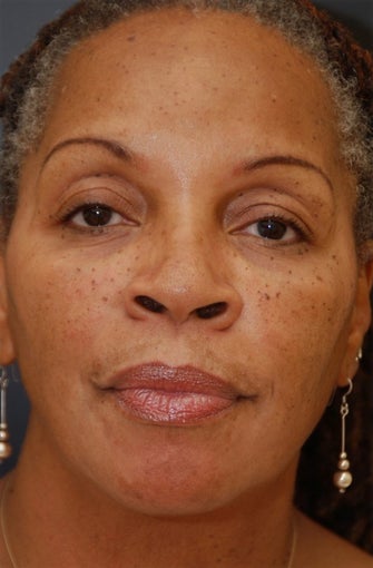 African American female treated with cheek augmentation filler and ZO Skin Health after 1412781