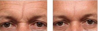 Botox and Fillers to Improve Frown Area before 1030388