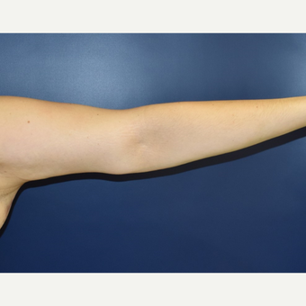 25-34 year old woman treated with Arm Lift after 3489804