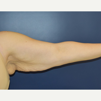 25-34 year old woman treated with Arm Lift before 3489804