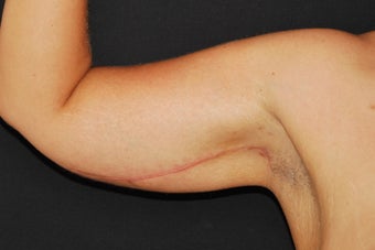 Brachioplasty after 949027