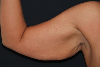 Brachioplasty before 949027