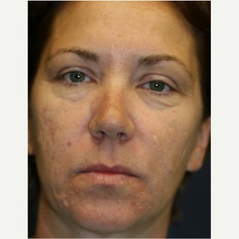 45-54 year old woman treated with Laser Peel before 2062958