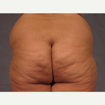 35-44 year old woman treated with Brazilian Butt Lift before 3308508