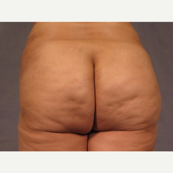 35-44 year old woman treated with Brazilian Butt Lift after 3308508