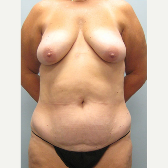 52 year old woman treated with Mommy Makeover before 3680079