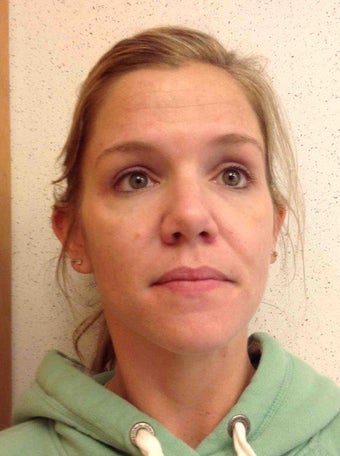 Accutane after 1346883