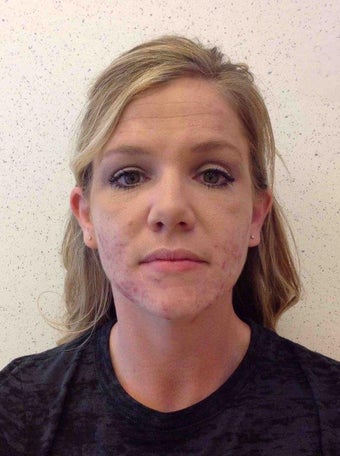 Accutane before 1346883