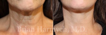 62 year-old female before and 3.5 months after Facelift and Fat Transfer (Autologous Fat Transplant) before 3445886