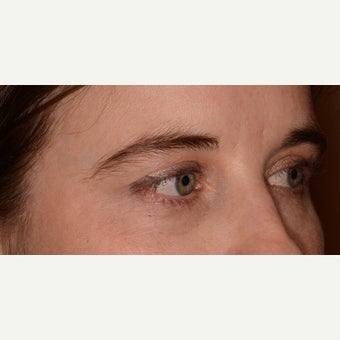 Undereye revolumization with Belotero 1643043