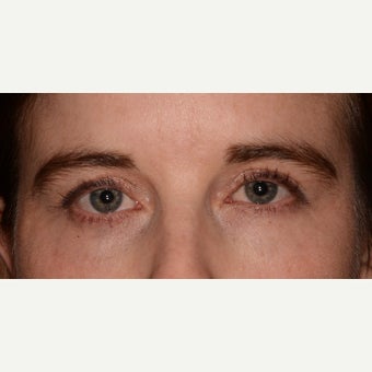 Undereye revolumization with Belotero after 1643043