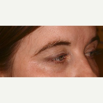 Undereye revolumization with Belotero 1643043