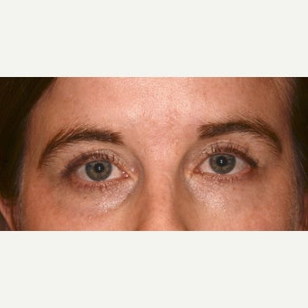Undereye revolumization with Belotero before 1643043