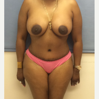 35-44 year old woman treated with Mommy Makeover after 3169458