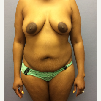 35-44 year old woman treated with Mommy Makeover before 3169458
