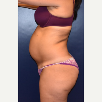 35-44 year old woman treated with Tummy Tuck before 3631391