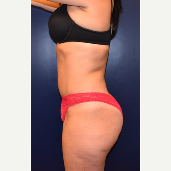 35-44 year old woman treated with Tummy Tuck after 3631391