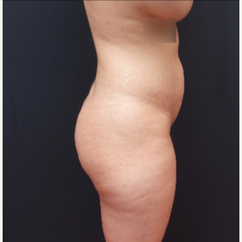 25-34 year old woman treated with Butt Lift before 3267070