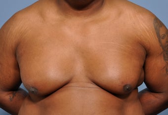 50 Year Old Male Treated For Severe Gynecomastia before 972853