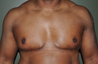 50 Year Old Male Treated For Severe Gynecomastia after 972853