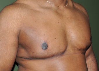 50 Year Old Male Treated For Severe Gynecomastia 972853