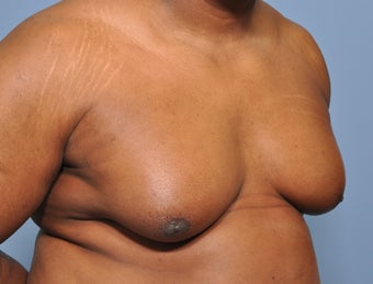 50 Year Old Male Treated For Severe Gynecomastia 972853