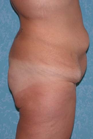 Buttock Augmentation with Circumferential Body Lift before 857508