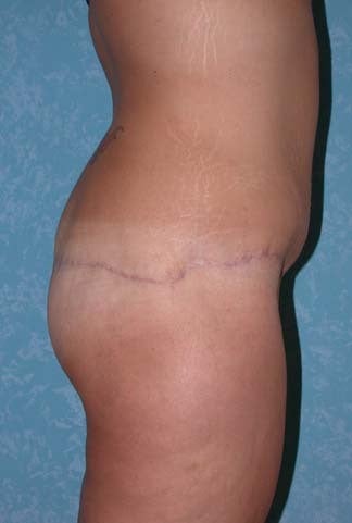 Buttock Augmentation with Circumferential Body Lift after 857508