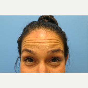 25-34 year old woman treated with Botox before 3822592