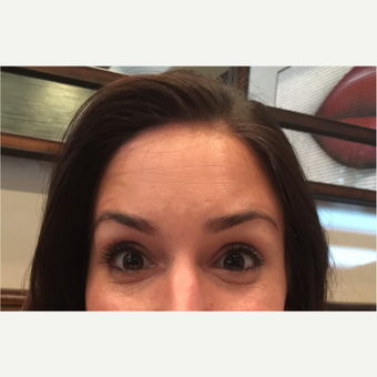25-34 year old woman treated with Botox after 3822592