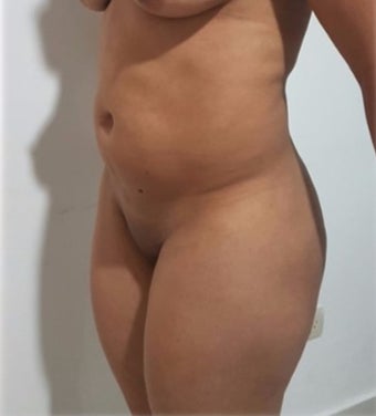 25-34 year old woman treated with Liposculpture post tummy tuck, 2 months post op. before 3288196