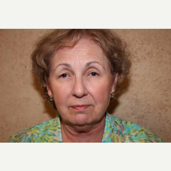 Facelift before 3454734