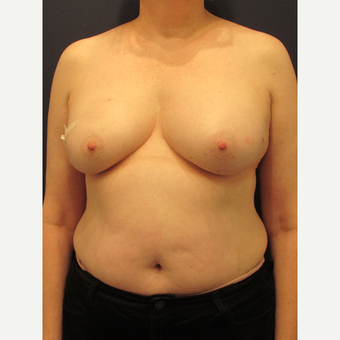 55-64 year old woman treated with Breast Reconstruction before 3691071