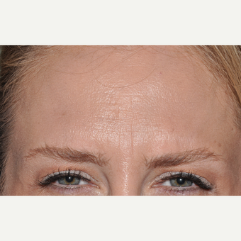 Botox for Glabellar Rhytids after 3374932
