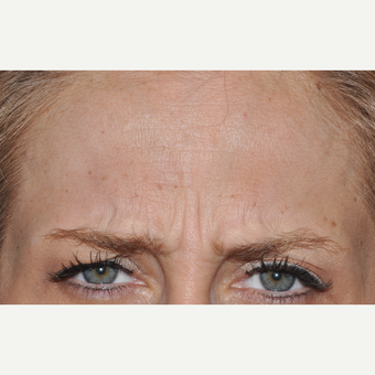 Botox for Glabellar Rhytids before 3374932