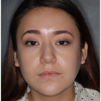 18-24 year old woman treated with Rhinoplasty 1 year post-op before 3708680