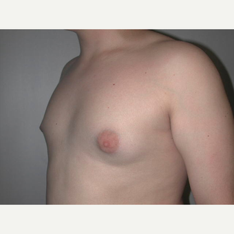 25-34 year old man treated with Male Breast Reduction before 3727293