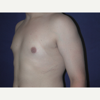 25-34 year old man treated with Male Breast Reduction after 3727293