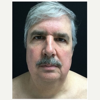 55-64 year old man treated with Facelift after 3219489