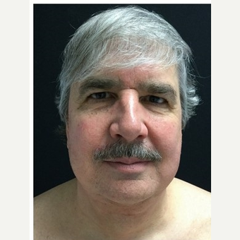 55-64 year old man treated with Facelift before 3219489