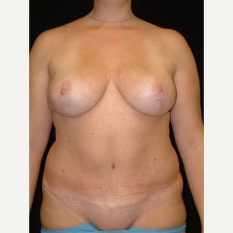 35-44 year old woman treated with Mommy Makeover Fully Tummy Tuck and Vertical Breast Lift after 3141763