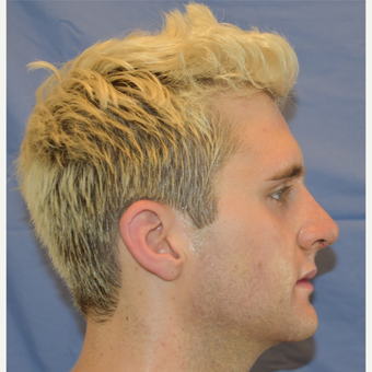 18-24 year old man treated with Nose Surgery after 3191416