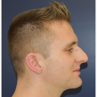 18-24 year old man treated with Nose Surgery before 3191416