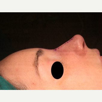 25-34 year old woman treated with Rhinoplasty after 3211322