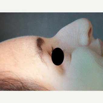 25-34 year old woman treated with Rhinoplasty before 3211322