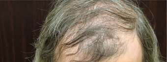 NeoGraft hair transplant before 562047