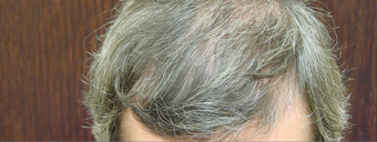 NeoGraft hair transplant after 562047
