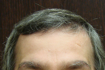 NeoGraft hair transplant 562047