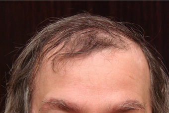 NeoGraft hair transplant 562047