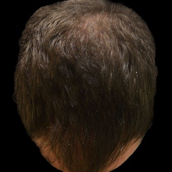 25-34 year old man treated with Hair Loss Treatment after 1736158
